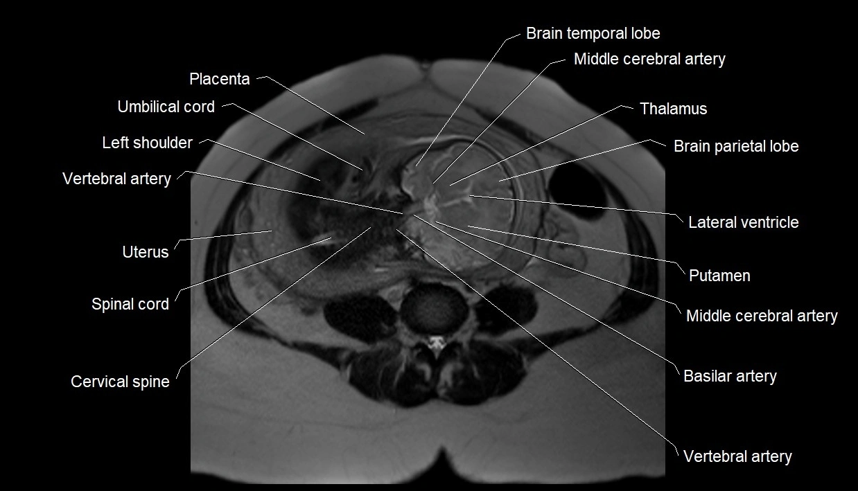 MRI fetal anatomy axial image 20.webp
